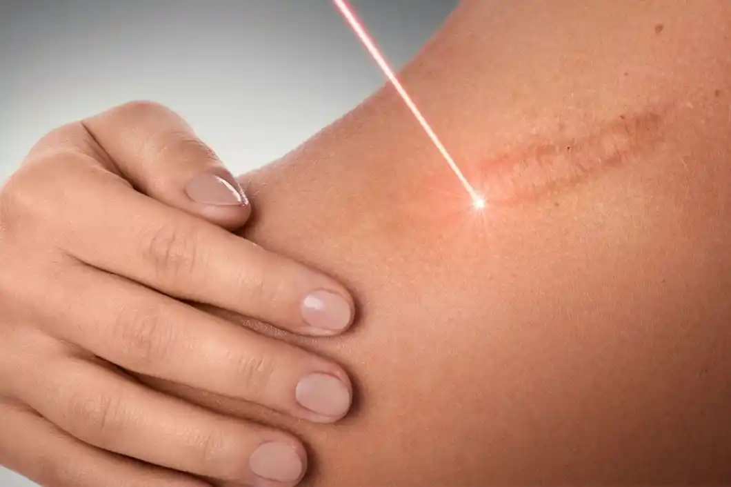 Stretch mark Removal