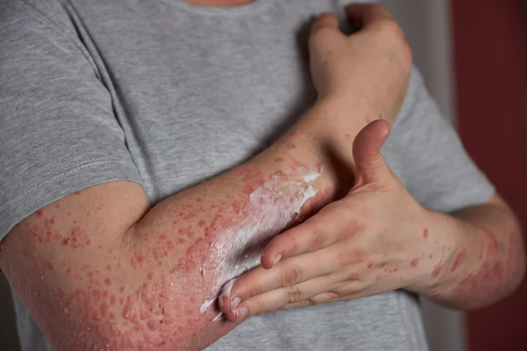 What is Psoriasis, Best Dermatologist in Newtown, Kolkata