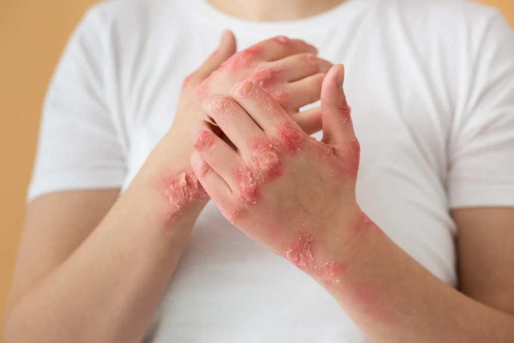 What is Psoriasis, Best Dermatologist in Newtown, Kolkata