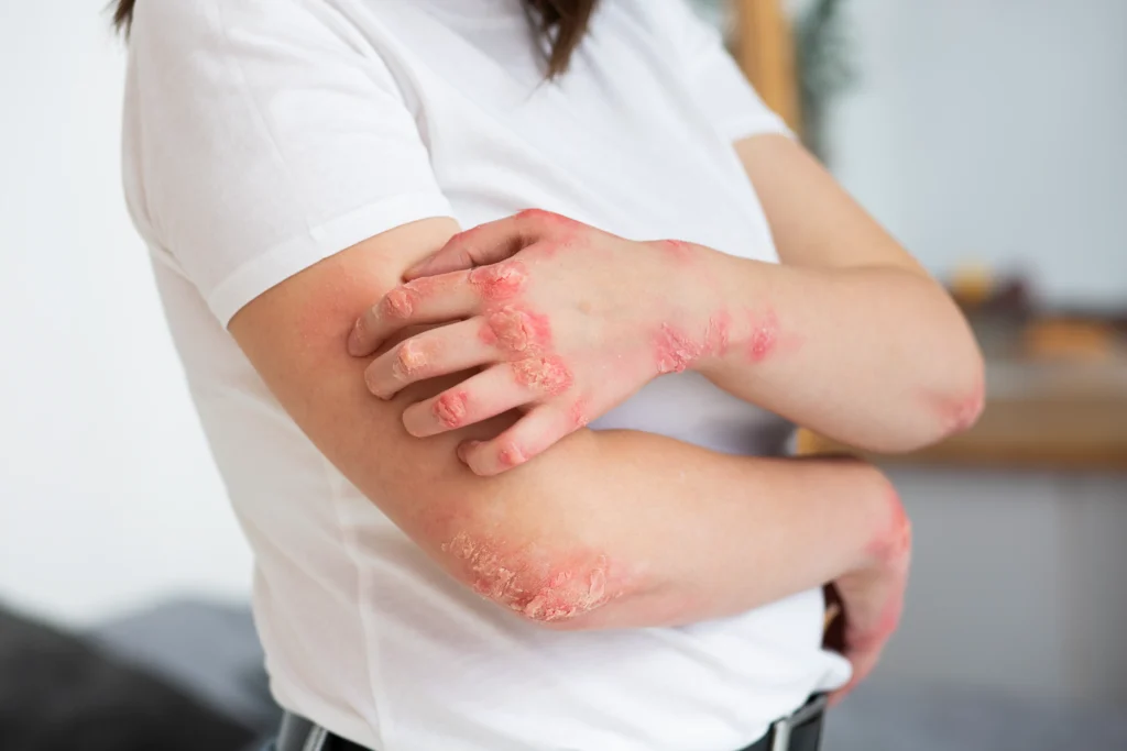 What is Psoriasis, Best Dermatologist in Newtown, Kolkata