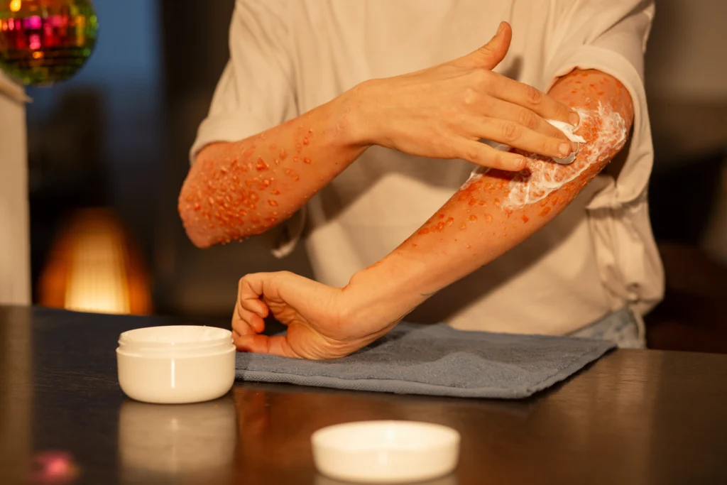What is Psoriasis, Best Dermatologist in Newtown, Kolkata